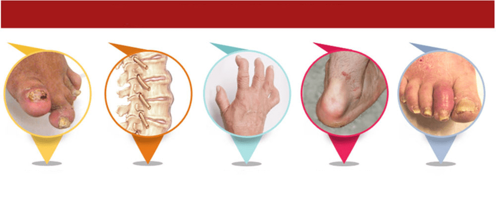 vrste psoriatičnega artritisa